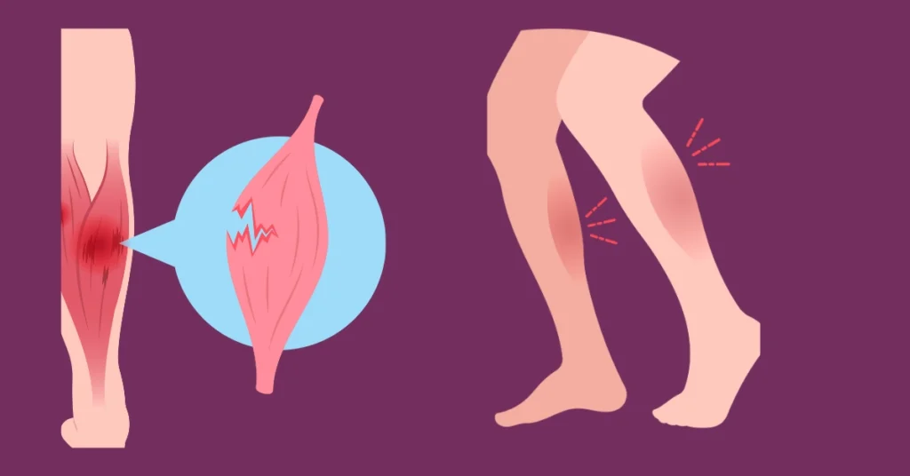 Illustration showing the difference between torn muscle vs pulled muscle in the lower leg, highlighting muscle fiber damage and pain zones.